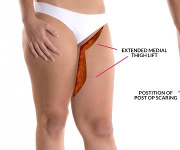 Thigh Lift